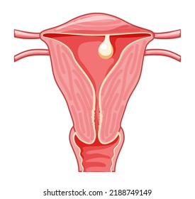 Pedunculated Polyp in the uterus Female reproductive system in cross sections. Front view in a cut. Human anatomy diseases internal organs location scheme, cervix, ovary flat style icon