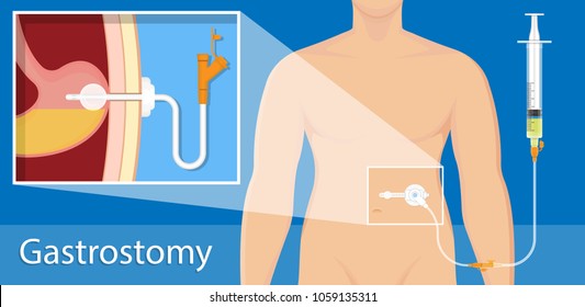 PEG Gastric Nasojejunal Orogastric Inserted Nasoduodenal Gastrojejunostomy Jejunostomy Nares Nostril Percutaneous Endoscopic Gastrostomy NG Feeding Tube Food Supplement Injecting