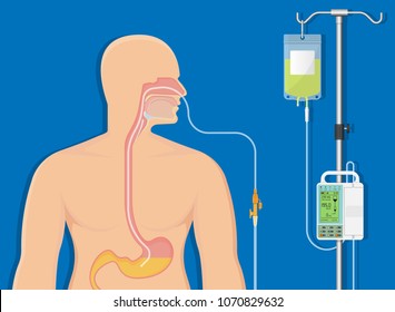 PEG Gastric Nasojejunal Orogastric Inserted Nasoduodenal Gastrojejunostomy Jejunostomy Nares Nostril Percutaneous Endoscopic Gastrostomy NG Feeding Tube Food Supplement Injecting