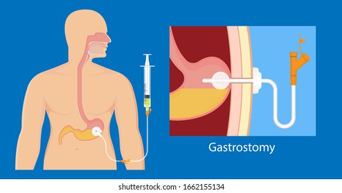 PEG Gastric Nasojejunal Orogastric Inserted Nasoduodenal Gastrojejunostomy Jejunostomy Nares Nostril Percutaneous Endoscopic Gastrostomy NG Feeding Tube Food Supplement Injecting