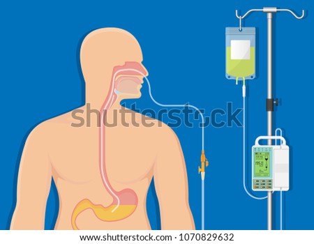 PEG gastric nasojejunal orogastric inserted nasoduodenal gastrojejunostomy jejunostomy nares nostril percutaneous endoscopic gastrostomy NG feeding tube food supplement injecting