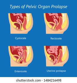 Pelvic Floor Prolapse Type Uterine Uterus Biofeedback Pelvic Floor Treatment Stage Degree Kegel Exercise Surgery Surgical Therapy Disorder Cystocele Urethrocele Vaginal Vault Enterocele Urethral Exam