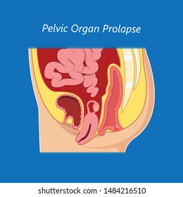 Pelvic Floor Prolapse Type Uterine Uterus Biofeedback Pelvic Floor Treatment Stage Degree Kegel Exercise Surgery Surgical Therapy Disorder Cystocele Urethrocele Vaginal Vault Enterocele Urethral Exam