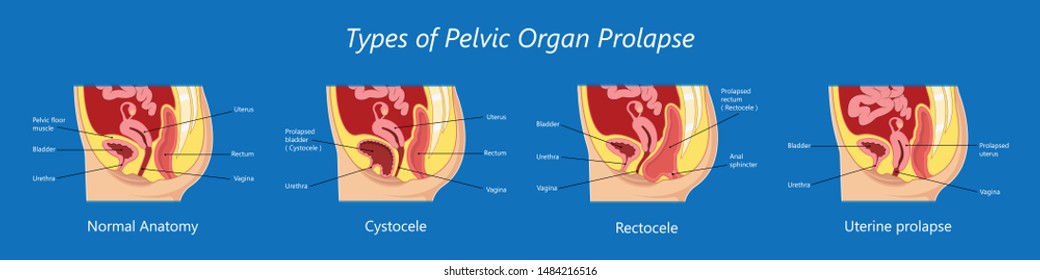 2 162 Pelvic Muscles Images Stock Photos Vectors Shutterstock   Pelvic Floor Prolapse Type Uterine 260nw 1484216516 