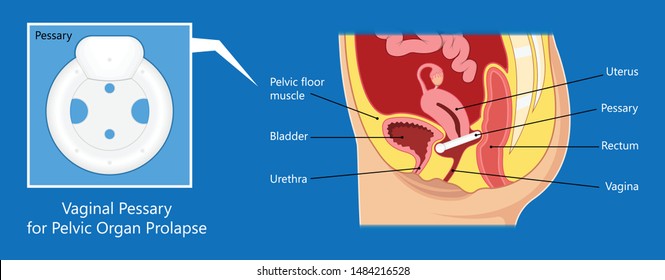 Pelvic Floor Prolapse Type Uterine Uterus Biofeedback Pelvic Floor Treatment Stage Degree Kegel Exercise Surgery Surgical Therapy Disorder Cystocele Urethrocele Vaginal Vault Enterocele Urethral Exam