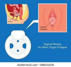 Pelvic Floor Prolapse Type Uterine Uterus Biofeedback Pelvic Floor Treatment Stage Degree Kegel Exercise Surgery Surgical Therapy Disorder Cystocele Urethrocele Vaginal Vault Enterocele Urethral Exam