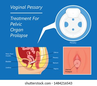 bladder prolapse pessary