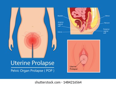 Pelvic Floor Prolapse Type Uterine Uterus Biofeedback Pelvic Floor Treatment Stage Degree Kegel Exercise Surgery Surgical Therapy Disorder Cystocele Urethrocele Vaginal Vault Enterocele Urethral Exam