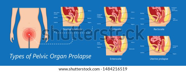 Pelvic Floor Prolapse Type Uterine Uterus Stock Vector