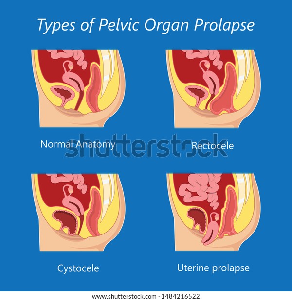 Pelvic Floor Prolapse Type Uterine Uterus Stock Vector Royalty