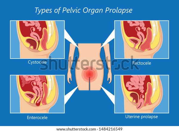 Pelvic Floor Prolapse Type Uterine Uterus Stock Vector Royalty