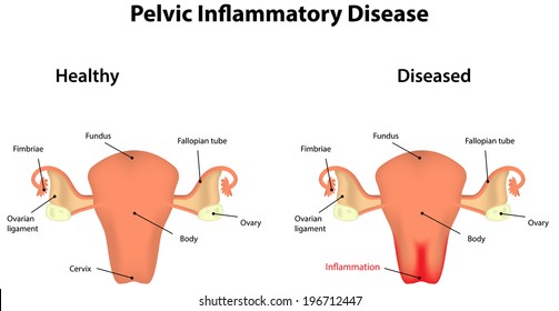 Enfermedad inflamatoria pélvica