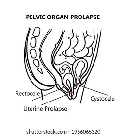 1 585 Prolapsed Images Stock Photos Vectors Shutterstock