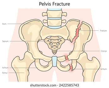 Pelvic pelvis fracture structure diagram hand drawn schematic vector illustration. Medical science educational illustration