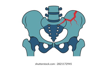 Pelvis bone fracture shown with red crack lines indicating skeletal injury in flat vector medical illustration.