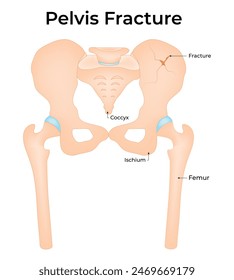 Pelvis Fracture Science Design Vector Illustration Diagram