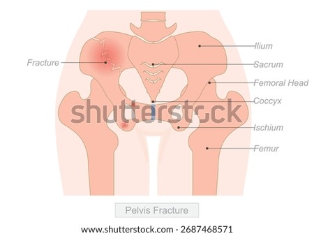 A pelvis fracture showing the broken bones of the pelvic region. Often caused by high-impact trauma or falls, especially in elderly patients or those with osteoporosis.Medical vector illustration.
