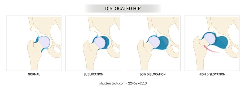 Pelvis labral tear bone broken and pain thighbone joint dislocated of leg treat unstable neck femur chronic prosthesis damage sport nerve sciatic compression child hurt thigh closed loose baby birth