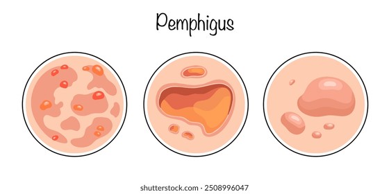 Pemphigus. Autoimmune pathology of the skin and mucous membranes, for which intraepithelial blisters are formed. Hand-drawn variants of the manifestation of the disease. Color vector illustration.