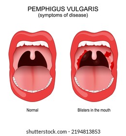 Pemphigus vulgaris. problem with the immune system. person wit affected area inside the mouth and throat blisters. Early symptoms of disease. vector illustration