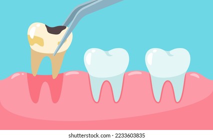 Pencabutan gigi berlubang vektor. gigi tidak sehat.
