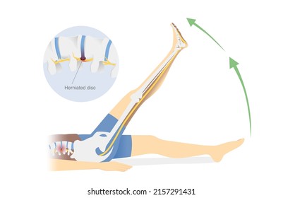 People doing sciatica stretches for pain relief from Herniated disc. Exercise diagram for back pain treatment with raising legs. Physical Therapy.