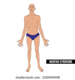 People with Marfan syndrome are tall and thin, and have long arms, legs, and fingers.