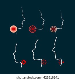 People Silhouettes With Ache Locations. Sore Throat Vector Illustrations. Men, Women And Kid Face Profiles. Icon Design For Medical Packaging Of Tablets, Pills, Spray Or Lozenges Local Impact.