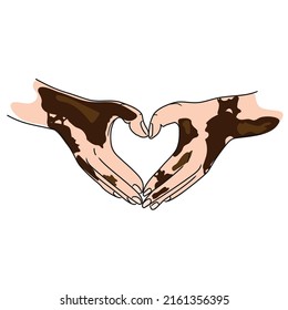 People with skin problems Vitiligo.Two hands making heart shape gesture vector illustration isolated on white background. World Vitiligo Day. Body positive self love concept.