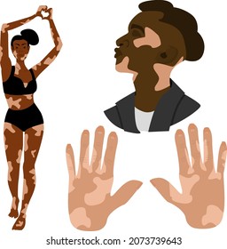 People vitiligo isolated. Hands with depigmentation. Flat vector illustration.