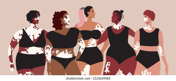 People with vitiligo spots on skin, different appearance. Flat vector stock illustration. Beautiful African and European women with depigmentation. Beauty of Vitiligo