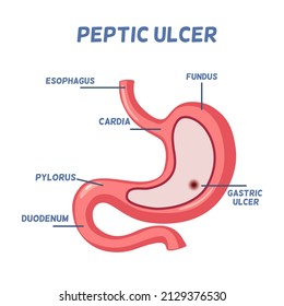 Peptic ulcer disease concept, a human gastric anatomy and wound in stomach, red spots in stomach, duodenum, cardia,esophagus,fungus,pylorus and gastric ulcer 