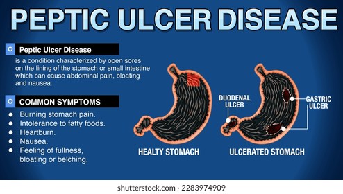 Ilustración infográfica de la enfermedad de úlcera péptica