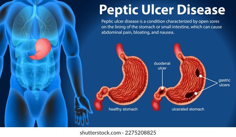 Peptic Ulcer Disease Infographic illustration