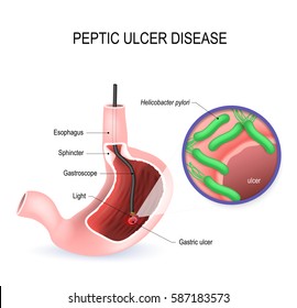 Peptic ulcer disease (PUD), stomach ulcer or gastric ulcer. Human Stomach with endoscope and close-up view of bacterium Helicobacter pylori which causes ulcers. vector diagram for textbooks