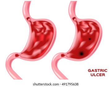 Peptic Ulcer Disease (PUD). Vector Illustration Of Diagram Of Human Stomach Anatomy Organ