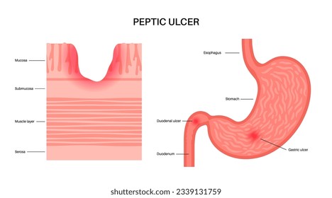 Peptic ulcer disease. Sore on wall of the stomach. Abdomen pain in the human body. Infection in the digestive tract. Gastroenterology concept. Gastric problems, anatomical flat vector illustration.