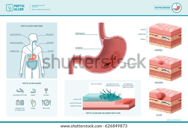 Peptic ulcer and helicobacter pylori\
infographic with symptoms and causes, stomach cross section\
diagram, medical\
illustration