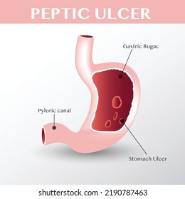 Peptic Ulcer Icon Vector Illustration For Designer.