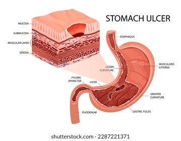 Úlcera péptica en infografía detallada de estómago, fondo blanco, estilo de caricatura
