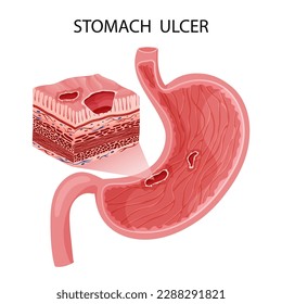 Peptic ulcer in stomach with detailed layers visualization. Vector illustration, cartoon style
