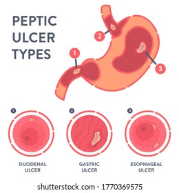 Peptic ulcer stomach disease infographic poster. Endoscopic image of stomach with duodenal, gastric and esophageal PUD. Digestive tract disorder. Health care and medical concept. Vector illustration. 