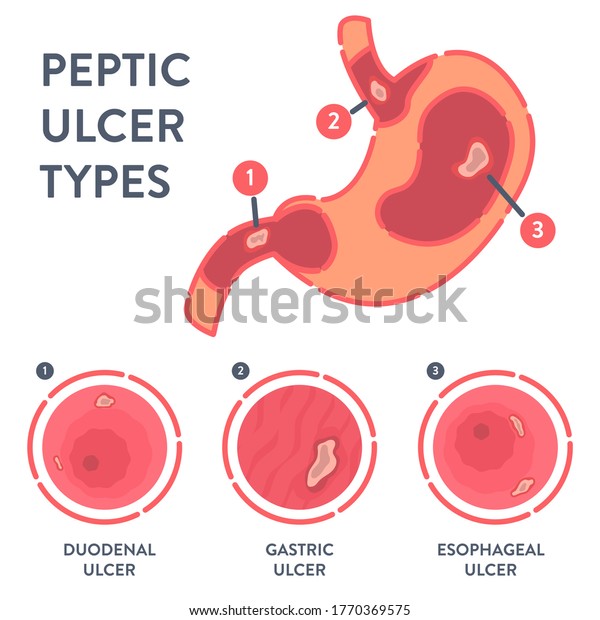 Peptic ulcer stomach disease infographic poster.\
Endoscopic image of stomach with duodenal, gastric and esophageal\
PUD. Digestive tract disorder. Health care and medical concept.\
Vector illustration. 