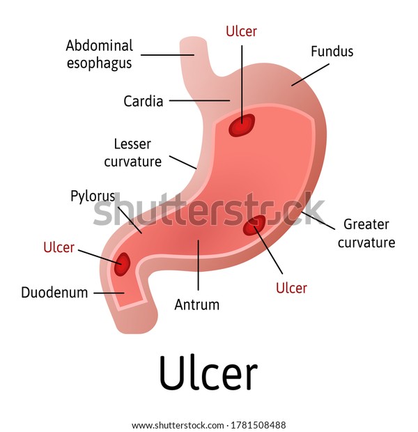 Peptic Ulcer Stomach Microscopic Colorful Anatomy Stock Vector (Royalty ...