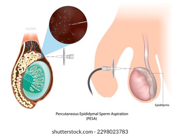 Percutaneous Epididymal Sperm Aspiration PESA. Testicular Biopsy. Epididymis. Azoospermia. Sperm retrieval techniques for azoospermic - Shutterstock ID 2298023783