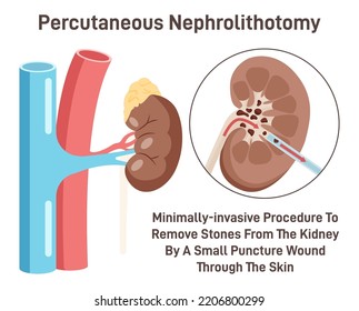 Perkutane Nephrolithotomie. Nierensteine, die chirurgische Eingriffe entfernen. Behandlung der Nephrolithiasis. Flache Vektorgrafik