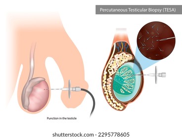 Percutaneous Testicular Biopsy or TESA. Punction in the testicle. Surgical Sperm Retrieval - Shutterstock ID 2295778605