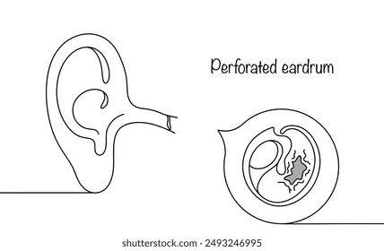 Perforated eardrum. Emergence holes in the eardrum due to infections and injuries to the middle ear. An organ disease accompanied by ear pain. Medical vector on white background.