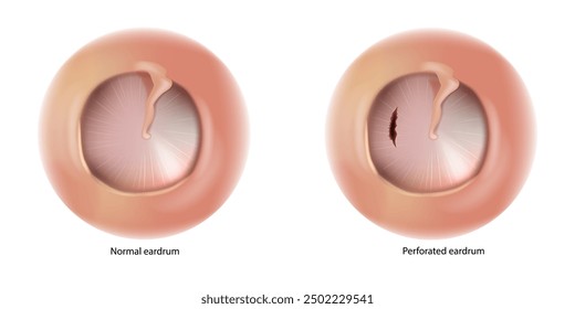 Perforated eardrum and Normal eardrum. Ruptured eardrum or Hole in the eardrum. 