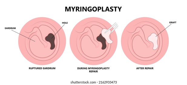 Perforated Eardrum Tube Surgical Drain Otitis Media Ear Wax Hole Repair Sound Canal Tear Pain Pus Bloody Hearing Loss Injury Middle Fluid Water Loud Blasts Microscopic Acute Bone Cotton Swab Otoscopic